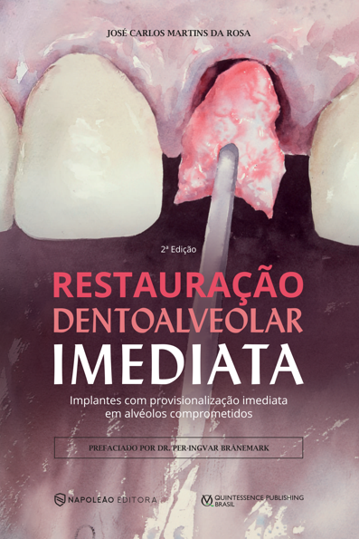 Restauração dentoalveolar imediata: implantes com provisionalização imedia...