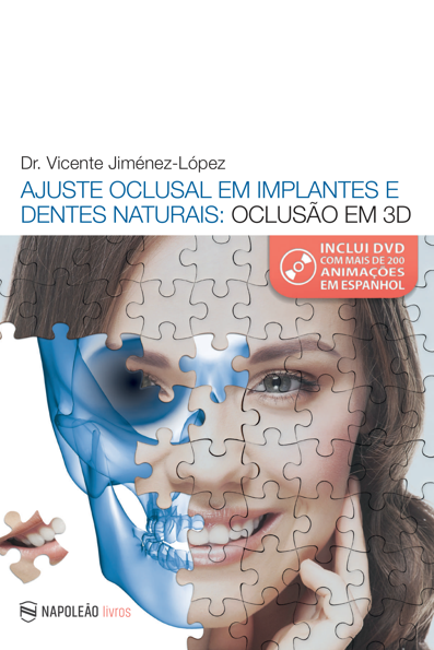 Ajuste oclusal em implantes e dentes naturais: oclusão em 3d